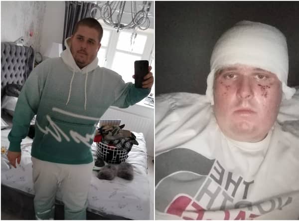 A student burned in a gas explosion which put him in a coma for 12 days said his life was saved - by his new Calvin Klein tracksuit