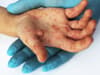 Hand foot and mouth disease: is it contagious in adults and children - early symptoms including rash explained