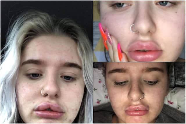 Anna Russell said she was convinced her lips were “too thin” (Photo: SWNS)