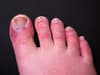 What is Covid toe? Symptoms of the condition, is there any treatment, and what causes it
