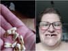 Desperate mum forced to pull out 11 of her teeth because she couldn’t afford the dentist