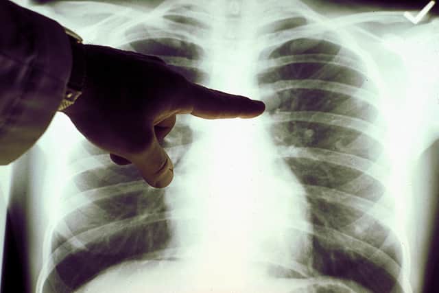 A chest x-ray will be the first step in diagnosing lung cancer (Photo: American Cancer Society via Getty Images)