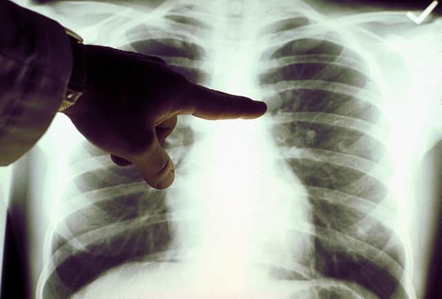 A chest x-ray will be the first step in diagnosing lung cancer (Photo: American Cancer Society via Getty Images)