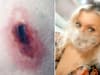 Woman had to be hospitalised three times after a spider bit her as she sat on the toilet 