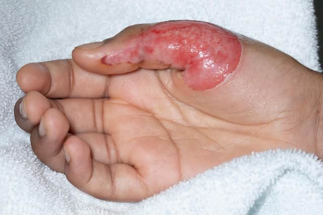 Skin blisters and scarring can be caused if the 160 degree dalgona sweet mixture comes into contact with skin. Parents are being advised to supervised children when making the sweet. (Credit: Birmingham NHS Trust)