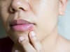 What is herpes? Symptoms of Simplex virus type 1 and 2, can you die from it, and what is the treatment
