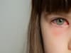 Can my child go to school with conjunctivitis? Symptoms of the eye condition, is it contagious and how to treat