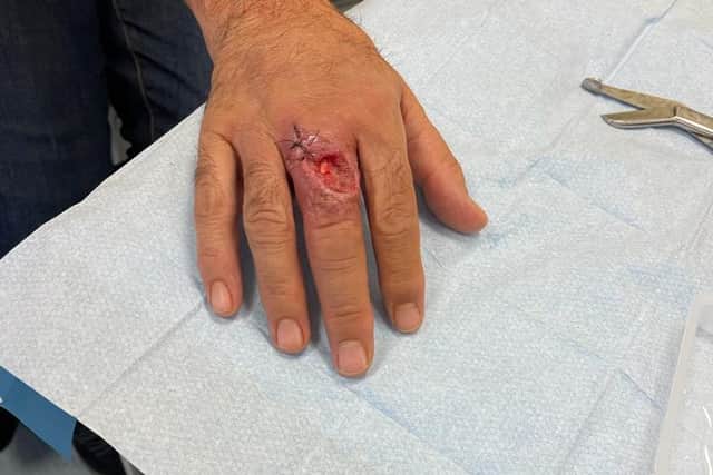 Dean Myatt, 58, suffered a horrific wound on his finger after being bitten by the venomous spider (Photo: Dean Myatt)