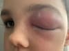Covid: Nine-year-old boy ‘almost went blind’ after catching coronavirus and suffering rare side effect 