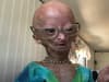 Adalia Rose death: who was YouTuber with progeria, what is syndrome - and how old was she when she died?