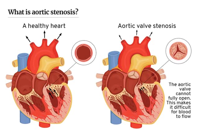 Aortic stenosis is a narrowing of the aortic valve opening, restricting the blood flow from the left ventricle to the aorta (Graphic: Kim Mogg/JPIMedia)