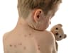 Measles vaccine: who can get jab, symptoms explained - and can you get illness twice?