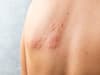 Can you get shingles from chickenpox? How long do symptoms last, is it contagious - and is there a treatment