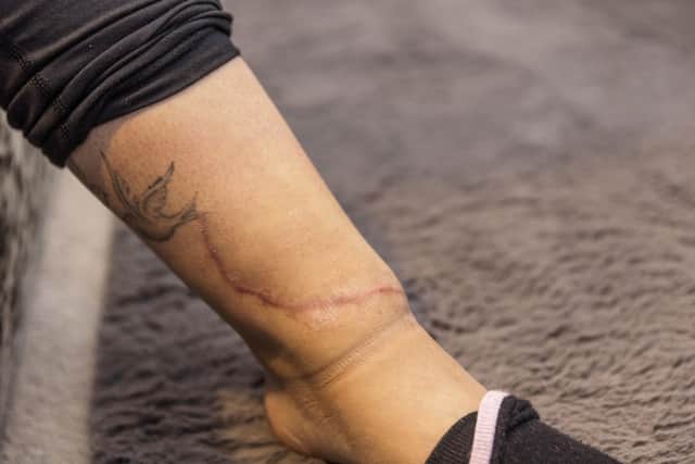 Aaliyah Lunn’s scars after the incident.