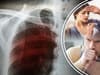 Tuberculosis: what are the symptoms of TB infection, and how do they differ from Covid - amid rising cases