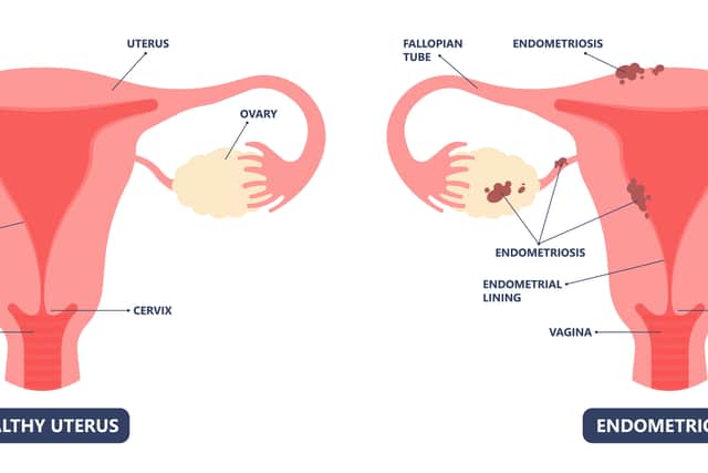 A graphic showing how endometriosis impacts the utuerus (Credit: rumruay - Adobe stock)