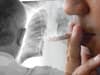 Lung cancer screening UK: NHS invites most at risk people to tests - who is eligible, what are the symptoms?