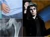 Liam Gallagher: arthritis in hips explained, will it affect Knebworth, replacement, symptoms - how old is he?