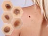 Skin cancer: signs to look out for including patches and moles - as May marks Skin Cancer Awareness Month 2022