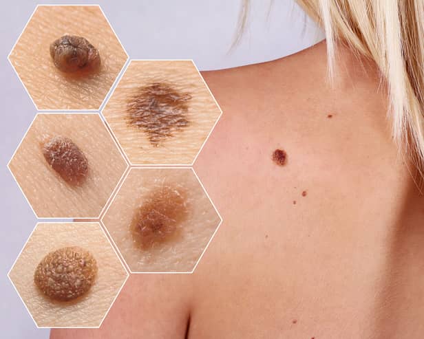 You should see a GP if you notice any change to your moles 