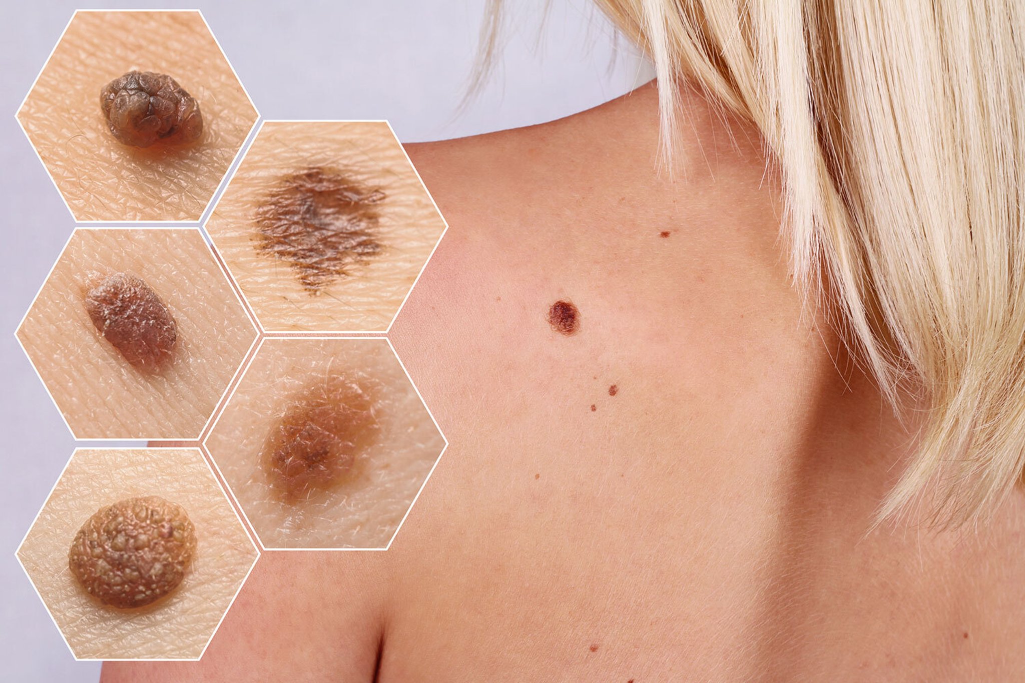 Skin cancer: signs to look out for including patches and moles | NationalWorld