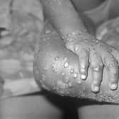 More Monkeypox UK cases set to be confirmed on Monday (image: Getty Images)