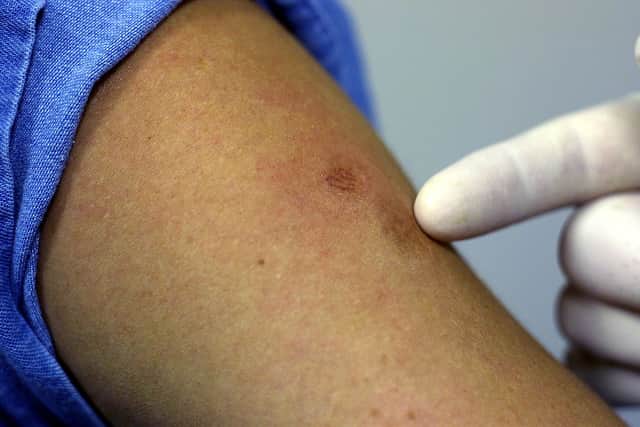 A doctor points out a patient’s scars from previous smallpox vaccinations (Photo: Chris Livingston/Getty Images)