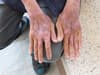 Scleroderma: symptoms, early signs, what is condition that led to Scotland man having double hand transplant?