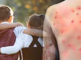 A rash usually begins one to five days after the first monkeypox symptoms appear