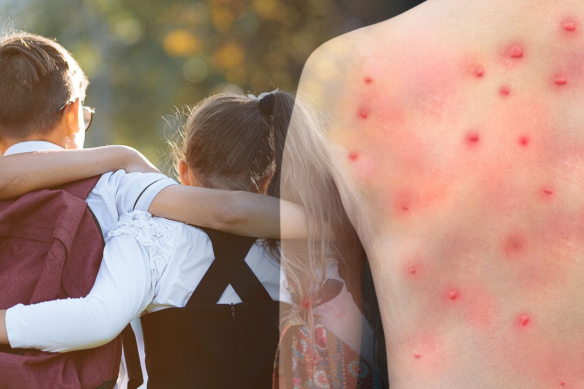 Is monkeypox worse in children? How severe virus is explained | NationalWorld