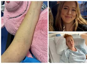 Student Alice Jenkins, 19,  told how she thought she had covid - but it was actually deadly meningitis.