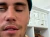 Ramsay Hunt Syndrome: what is Justin Bieber’s illness, why is part of his face paralysed, what is treatment?