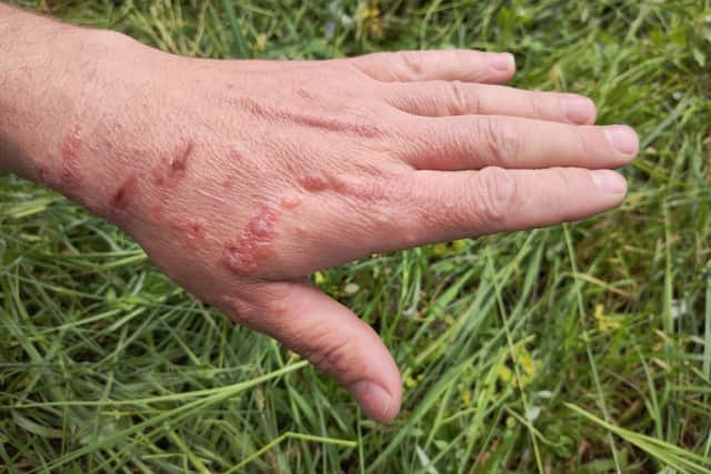 Giant hogweed can cause blisters, rashes and inflamed or irritated skin (Photo: Adobe)