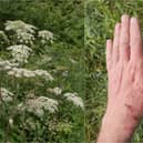 Giant hogweed can cause severe burns, blisters, painful skin irritation and even blindness (Photo: Adobe)