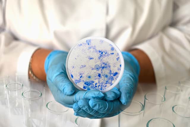 Trichomoniasis is an STI caused by a parasite called trichomonas vaginalis (TV)