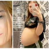 Hollie Welham, 21, thought she was pregnant, but it was an ovarian cyst which grew to be the size of a football.