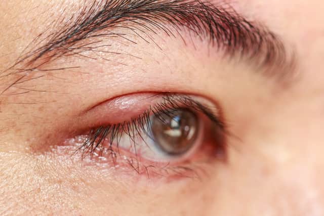 Blepharitis is a chronic inflammatory condition of the eyelids