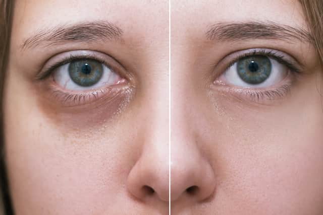 Volume loss under the eyes is one of the main causes of dark circles in this area