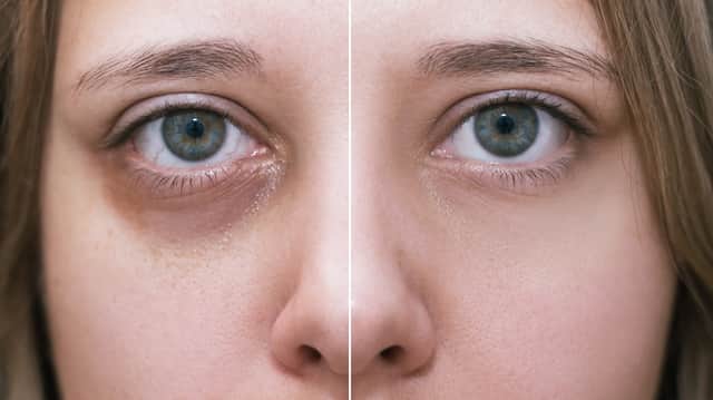 Volume loss under the eyes is one of the main causes of dark circles in this area