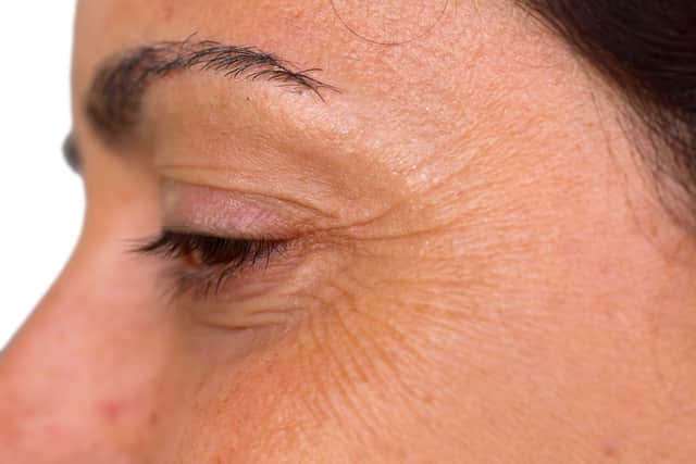Crow’s feet can occur during the menopause