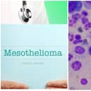 More than 2,000 people are diagnosed with mesothelioma a year in the UK.