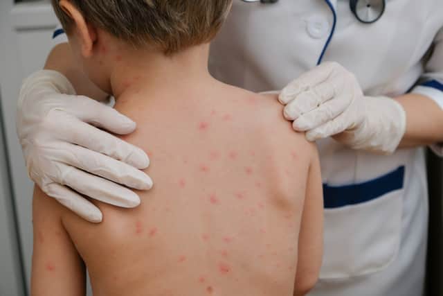 Chickenpox is a viral infection that mostly affects children, although you can get it at any age (Image: Adobe)