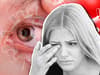Long Covid: 3 symptoms affecting your eyesight that could last for months post-infection