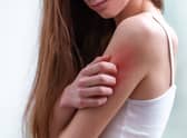 The symptoms of heat rash are often the same in adults and children 