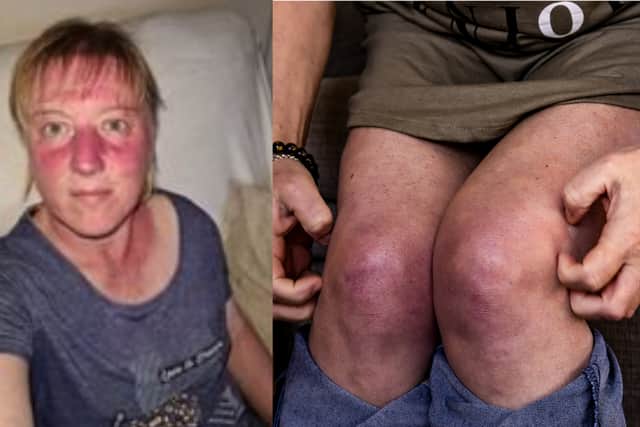 Her condition causes her to develop painful rashes and welts on her skin when she gets cold (Photo: Sam Newland / SWNS)
