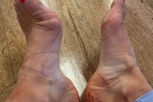 Strictly Come Dancing star Helen Skelton has revealed her painful-looking rehearsal injuries. (Picture: Instagram/ helenskelton)
