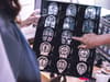 Alzheimer’s drug lecanemab hailed as ‘momentous’ breakthrough in slowing memory decline