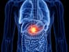 Pancreatic cancer symptoms: what they are, cancer’s risk factors and survival rate explained