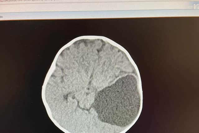 Scans of baby Ada’s brain cyst. Picture: Ella Dean / SWNS
