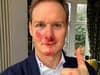 What happened to Dan Walker? What did TV presenter say about bike crash accident, what injuries did he sustain?